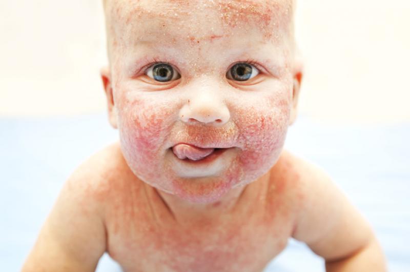 Hoe wordt atopisch eczeem vastgesteld? Pfizer